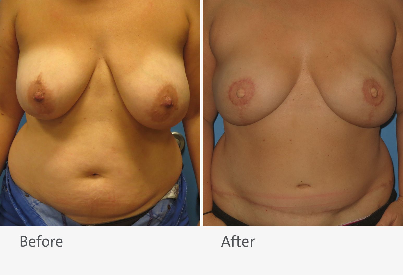 A patient is shown before and after breast reconstruction with a DIEP flap. On the left is the patient before the surgery with slightly uneven breasts, and on the right is the patient after surgery with smaller, more even breasts.